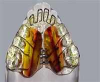 Hàm nâng khớp cắn Hàm nâng khớp cắn