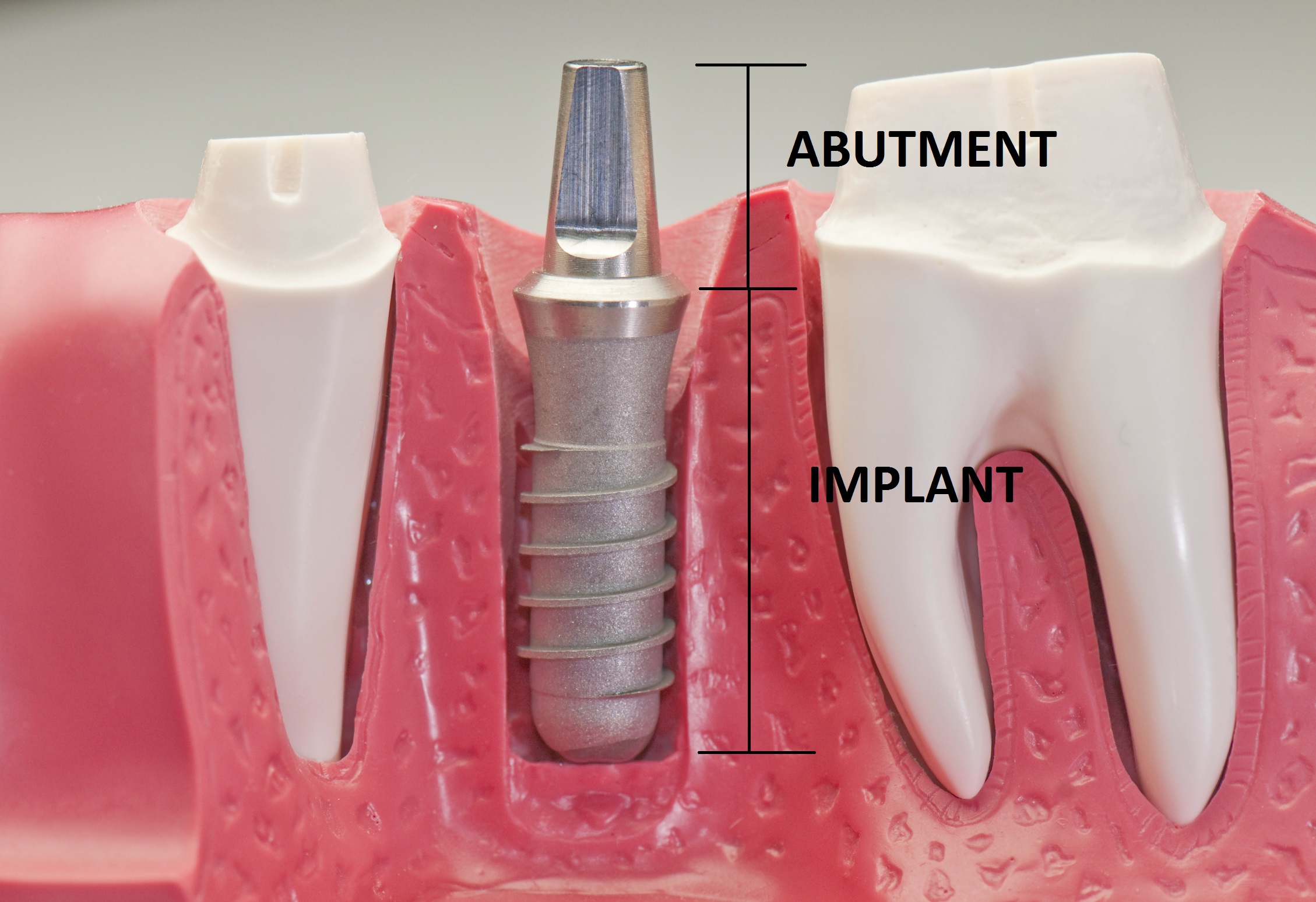 Abutment tùy chỉnh Abutment tùy chỉnh