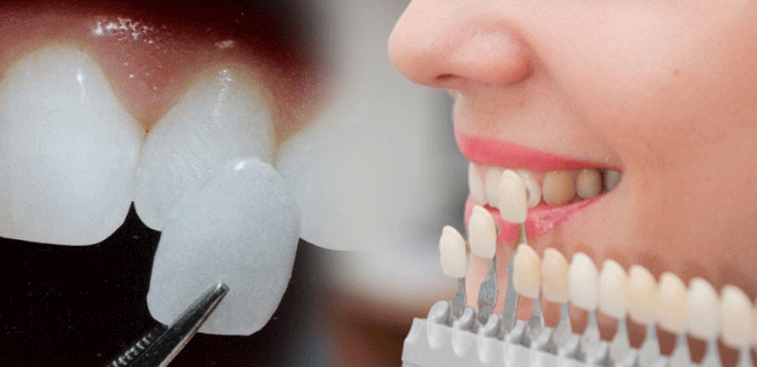 Mặt dán sứ Veneer Mặt dán sứ Veneer