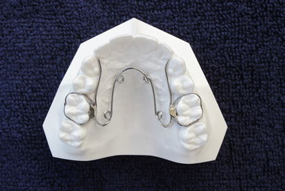 Hàm nắn QuardHelix Hàm nắn QuardHelix