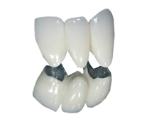 Răng thép sứ Răng thép sứ